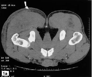 Gluteal mass in a bodybuilder: radiological depiction of complication of anabolic steroid use