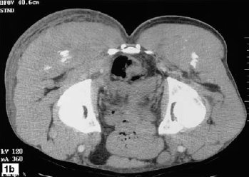 Gluteal mass in a bodybuilder: radiological depiction of complication of anabolic steroid use