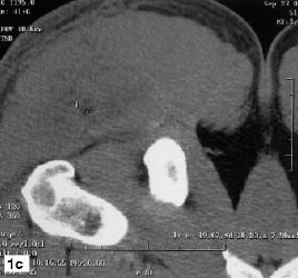 Gluteal mass in a bodybuilder: radiological depiction of complication of anabolic steroid use