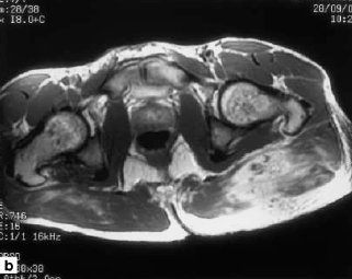 Gluteal mass in a bodybuilder: radiological depiction of complication of anabolic steroid use