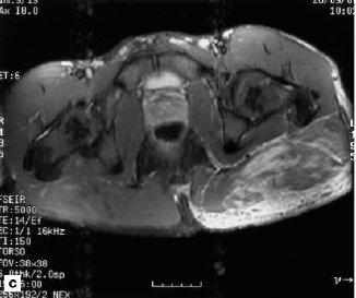 Gluteal mass in a bodybuilder: radiological depiction of complication of anabolic steroid use