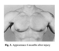 Website over afgescheurde pecs