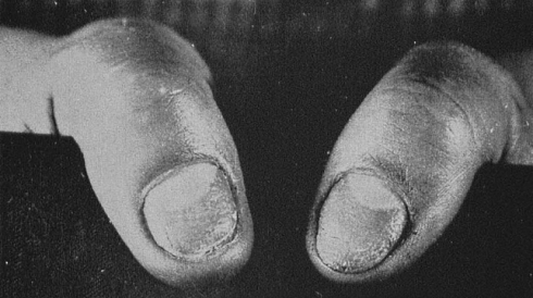 Broze nagels, die makkelijk splijten en niet meer glimmen, kunnen weer gezond worden door een dagelijkse inname van slechts zeven gram gelatine. Dat schreef de Amerikaanse arts Terence Lloyd Tyson in 1950 in de Journal of Investigative Dermatology.