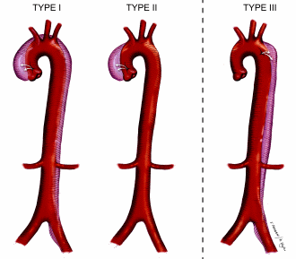 Anabolengebruiker scheurt aorta
