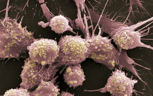 In het bloed van actieve mensen gaan prostaatkankercellen dood
