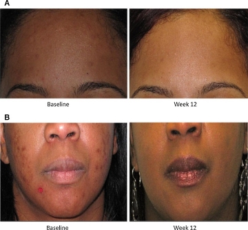 Vitamine B5 bestrijdt acne